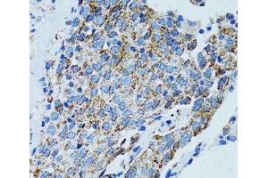 Immunohistochemistry of paraffin-embedded Human lung cancer using MRPL28 Polyclonal Antibody at dilution of 1:100 (40x lens). (MRPL28 Antikörper)