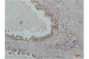 Immunohistochemistry (IHC) analysis of paraffin-embedded Human Lung Carcinoma using IkappaB beta(Mouse Monoclonal Antibody diluted at 1:200. (NFKBIB Antikörper)