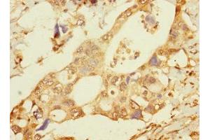 Immunohistochemistry of paraffin-embedded human pancreatic cancer using ABIN7165454 at dilution of 1:100 (FAM187B Antikörper  (AA 18-335))