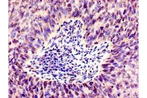 Immunohistochemistry of paraffin-embedded human cervical cancer using ABIN7171071 at dilution of 1:100