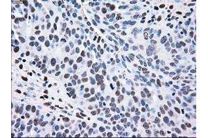 Immunohistochemical staining of paraffin-embedded Adenocarcinoma of breast tissue using anti-MAP2K2 mouse monoclonal antibody. (MEK2 Antikörper)