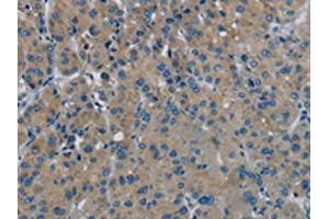 The image on the left is immunohistochemistry of paraffin-embedded Human liver cancer tissue using ABIN7191867(PHKG1 Antibody) at dilution 1/20, on the right is treated with synthetic peptide. (PHKG1 Antikörper)