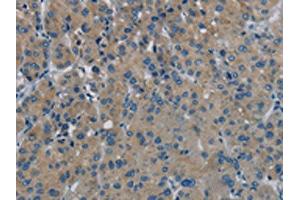The image on the left is immunohistochemistry of paraffin-embedded Human liver cancer tissue using ABIN7191867(PHKG1 Antibody) at dilution 1/20, on the right is treated with synthetic peptide.