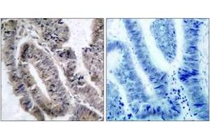 Immunohistochemistry analysis of paraffin-embedded human colon carcinoma, using AMPK1 (Phospho-Ser485) Antibody. (PRKAA1 Antikörper  (pSer496))
