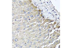 Immunohistochemistry of paraffin-embedded human liver injury using MGAT1 antibody at dilution of 1:100 (x40 lens).