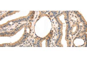 Immunohistochemistry of paraffin-embedded Human thyroid cancer tissue using TRIB3 Polyclonal Antibody at dilution 1:40 (TRIB3 Antikörper)