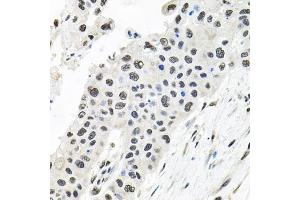 Immunohistochemistry of paraffin-embedded human lung cancer using CDC antibody (ABIN6127612, ABIN6138273, ABIN6138274 and ABIN6216282) at dilution of 1:100 (40x lens). (CDCA8 Antikörper  (AA 1-280))