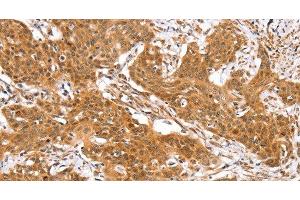 Immunohistochemistry of paraffin-embedded Human cervical cancer using RGS22 Polyclonal Antibody at dilution of 1:40 (RGS22 Antikörper)