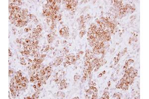 IHC-P Image Immunohistochemical analysis of paraffin-embedded human breast cancer, using HLA-DMA, antibody at 1:250 dilution.