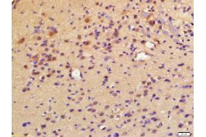 Formalin-fixed and paraffin embedded labeled with Rabbit Anti-LPCAT2 Polyclonal Antibody, Unconjugated (ABIN2177389) at 1:200 followed by conjugation to the secondary antibody and DAB staining (LPCAT2 Antikörper  (AA 131-230))