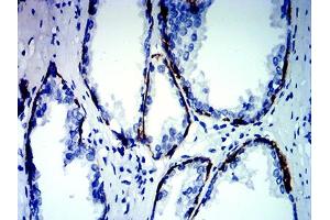 Immunohistochemical analysis of paraffin-embedded prostate cancer tissues using KRT13 mouse mAb with DAB staining. (Cytokeratin 13 Antikörper  (AA 104-458))
