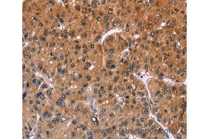 Immunohistochemistry of Human liver cancer using ING2 Polyclonal Antibody at dilution of 1:40 (ING2 Antikörper)