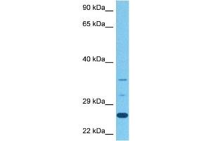 Host:  Rabbit  Target Name:  STEAP1  Sample Tissue:  Human Stomach Tumor  Antibody Dilution:  1ug/ml (STEAP1B Antikörper  (N-Term))
