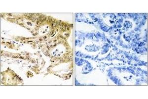 Immunohistochemistry analysis of paraffin-embedded human colon carcinoma tissue, using MED23 Antibody.