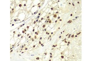 Immunohistochemistry of paraffin-embedded Human kidney cancer using RPA2 Polyclonal Antibody at dilution of 1:100 (40x lens). (RPA2 Antikörper)