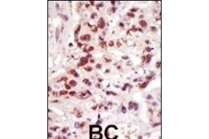 Formalin-fixed and paraffin-embedded human cancer tissue reacted with the primary antibody, which was peroxidase-conjugated to the secondary antibody, followed by DAB staining. (MAP3K8 Antikörper  (C-Term))