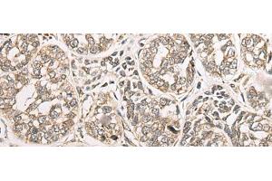 Immunohistochemistry of paraffin-embedded Human esophagus cancer tissue using COA7 Polyclonal Antibody at dilution of 1:55(x200) (C1orf163 Antikörper)
