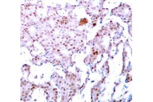 Immunohistochemistry of paraffin-embedded human breast carcinoma using Phospho-RELA-S536 antibody (ABIN2987368). (NF-kB p65 Antikörper  (pSer536))