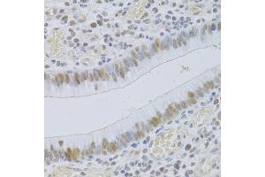 Immunohistochemistry of paraffin-embedded human gastric cancer using JMJD6 Antibody (ABIN5973452) at dilution of 1/100 (40x lens). (JMJD6 Antikörper)