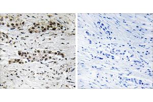 P-peptide - +Immunohistochemistry analysis of paraffin-embedded human breast carcinoma tissue using Estrogen Receptor-α (Phospho-Ser102) antibody. (Estrogen Receptor alpha Antikörper  (pSer102))