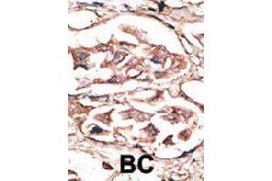 Formalin-fixed and paraffin-embedded human cancer tissue reacted with DKK2 polyclonal antibody  , which was peroxidase-conjugated to the secondary antibody, followed by AEC staining. (DKK2 Antikörper  (C-Term))