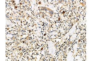 ABIN6261700 and ABIN6276598 at 1/100 staining Human kidney cancer by IHC-P.