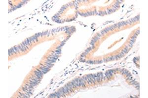 The image on the left is immunohistochemistry of paraffin-embedded Human colon cancer tissue using ABIN7189634(ACR Antibody) at dilution 1/20, on the right is treated with synthetic peptide. (Acrosin Antikörper)