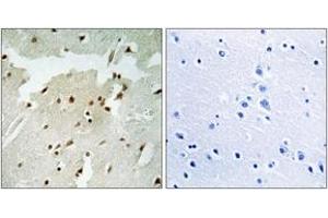 Immunohistochemistry analysis of paraffin-embedded human lung carcinoma, using Ku70 (Phospho-Ser5) Antibody. (XRCC6 Antikörper  (pSer5))