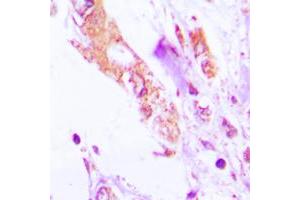 Immunohistochemical analysis of IL-1 beta staining in human lung cancer formalin fixed paraffin embedded tissue section. (IL-1 beta Antikörper  (Center))