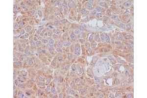 Immunohistochemical analysis of paraffin-embedded human lung cancer, using ATG9A Antibody. (Rekombinanter ATG9A Antikörper)
