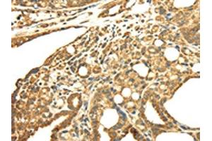 The image on the left is immunohistochemistry of paraffin-embedded Human thyroid cancer tissue using ABIN7128021(SRPRB Antibody) at dilution 1/30, on the right is treated with fusion protein.