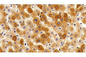 Detection of ORM2 in Human liver Cirrhosis Tissue using Polyclonal Antibody to Orosomucoid 2 (ORM2)