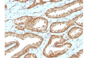 Formalin-fixed, paraffin-embedded human Prostate Carcinoma stained with YBX1 Mouse Recombinant Monoclonal Antibody (rYBX1/2430). (Rekombinanter YBX1 Antikörper)