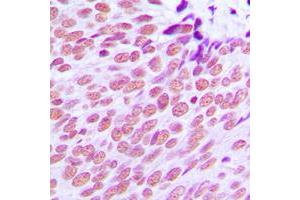 Immunohistochemical analysis of Estrogen Receptor alpha staining in human breast cancer formalin fixed paraffin embedded tissue section.