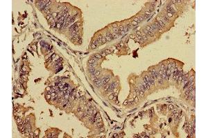 Immunohistochemistry of paraffin-embedded human endometrial cancer using ABIN7164730 at dilution of 1:100 (PREB Antikörper  (AA 98-283))