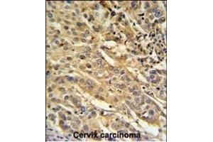 F91A1 Antibody (N-term) (ABIN651217 and ABIN2840136) IHC analysis in formalin fixed and paraffin embedded human cervix carcinoma followed by peroxidase conjugation of the secondary antibody and DAB staining. (FAM91A1 Antikörper  (N-Term))