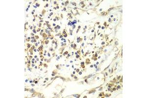 Immunohistochemistry of paraffin-embedded human liver cancer using UPF1 antibody. (RENT1/UPF1 Antikörper  (AA 270-370))