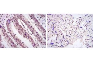 Immunohistochemical analysis of paraffin-embedded rectum cancer tissues (left) and placenta tissues (right) using CDK9 mouse mAb with DAB staining. (CDK9 Antikörper)