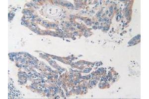 IHC-P analysis of Human Rectum Cancer Tissue, with DAB staining. (MVP Antikörper  (AA 2-272))