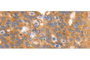 Immunohistochemistry of paraffin-embedded Human ovarian cancer tissue using MYOD1 Polyclonal Antibody at dilution of 1:120(x200)