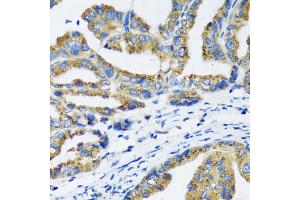 Immunohistochemistry of paraffin-embedded human gastric cancer using NFKB1 antibody (ABIN6292205) at dilution of 1:100 (40x lens). (NFKB1 Antikörper)