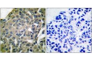 Immunohistochemistry analysis of paraffin-embedded human breast carcinoma tissue, using GRP94 Antibody.