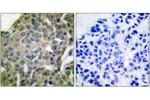 Immunohistochemistry analysis of paraffin-embedded human breast carcinoma tissue, using GRP94 Antibody. (GRP94 Antikörper  (AA 754-803))