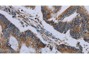 Immunohistochemistry of paraffin-embedded Human colon cancer using NDUFA13 Polyclonal Antibody at dilution of 1:50 (NDUFA13 Antikörper)