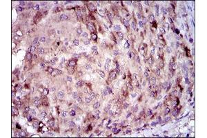 Immunohistochemical analysis of paraffin-embedded liver cancer tissues using CRP mouse mAb with DAB staining. (CRP Antikörper)