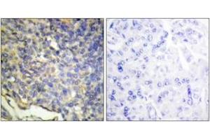 Immunohistochemistry analysis of paraffin-embedded human breast carcinoma tissue, using DFFA Antibody. (DFFA Antikörper  (AA 151-200))