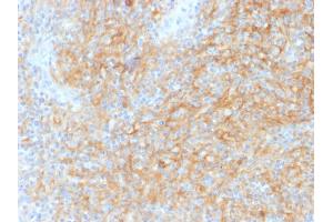Formalin-fixed, paraffin-embedded human Hodgkins Lymphoma stained with CD40 Mouse Monoclonal Antibody (C40/1605). (CD40 Antikörper)