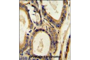 CCL4 Antibody immunohistochemistry analysis in formalin fixed and paraffin embedded human prostate carcinoma followed by peroxidase conjugation of the secondary antibody and DAB staining. (CCL4 Antikörper  (AA 22-48))