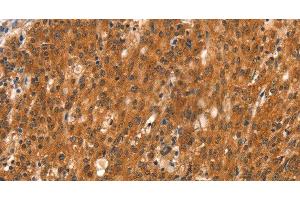 Immunohistochemistry of paraffin-embedded Human gasrtic cancer tissue using DAB2IP Polyclonal Antibody at dilution 1:40