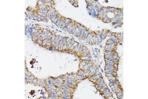 Immunohistochemistry of paraffin-embedded human colon carcinoma using MT-CYB antibody (ABIN7268595) at dilution of 1:100 (40x lens). (Cytochrome b Antikörper)